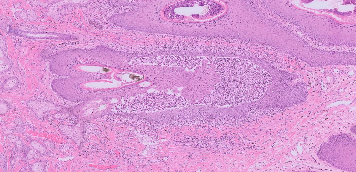 Case of the Month Trunk Predominant Pemphigus foliaceus Veterinary