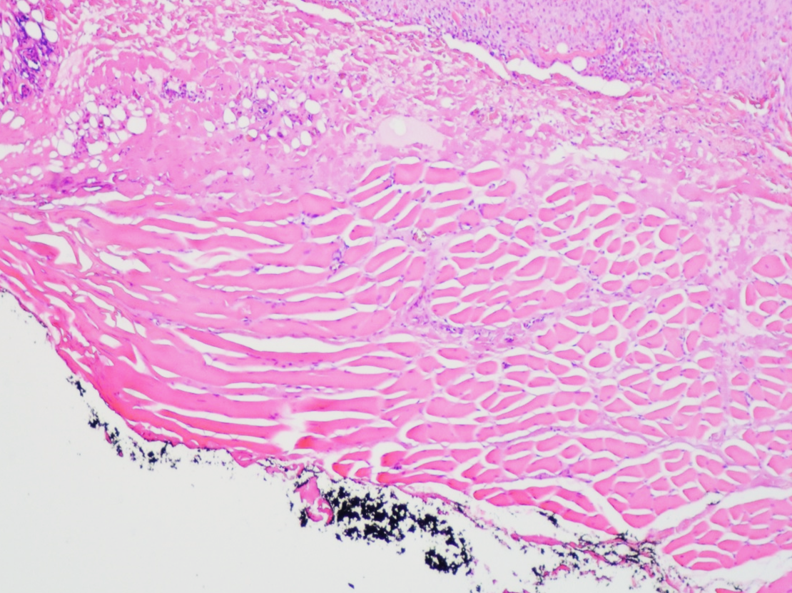 Histologic tumour margin assessment – general information, terminology ...